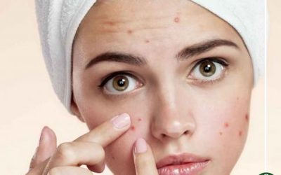 حب الشباب..أسبابه وعلاجه والوقاية منه ؟