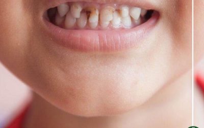 أسباب وأعراض تسوس الأسنان عند الاطفال