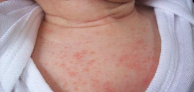 أدوية الحساسية للرضع