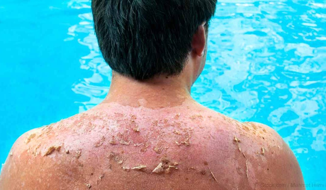 طرق علاج حروق الشمس والوقاية منها