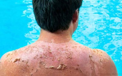طرق علاج حروق الشمس والوقاية منها