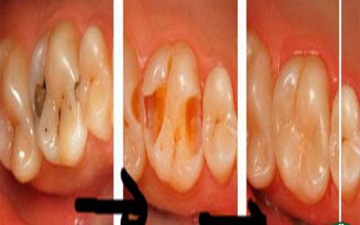 تجربتي مع علاج تسوس الأسنان بالأعشاب