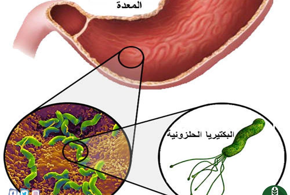 أعراض البكتريا الحلزونية في المعدة وكيفية حدوثها