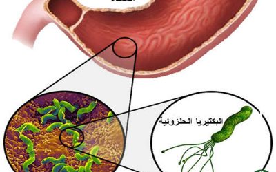 أعراض البكتريا الحلزونية في المعدة وكيفية حدوثها
